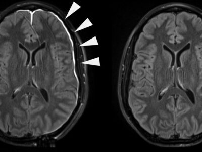 traumatic brain injuries